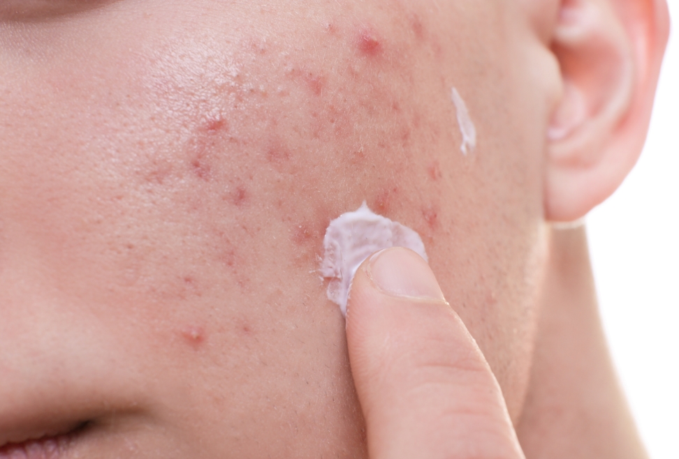 Faut-il traiter toute la zone affectée par l'acné ou juste les boutons?
