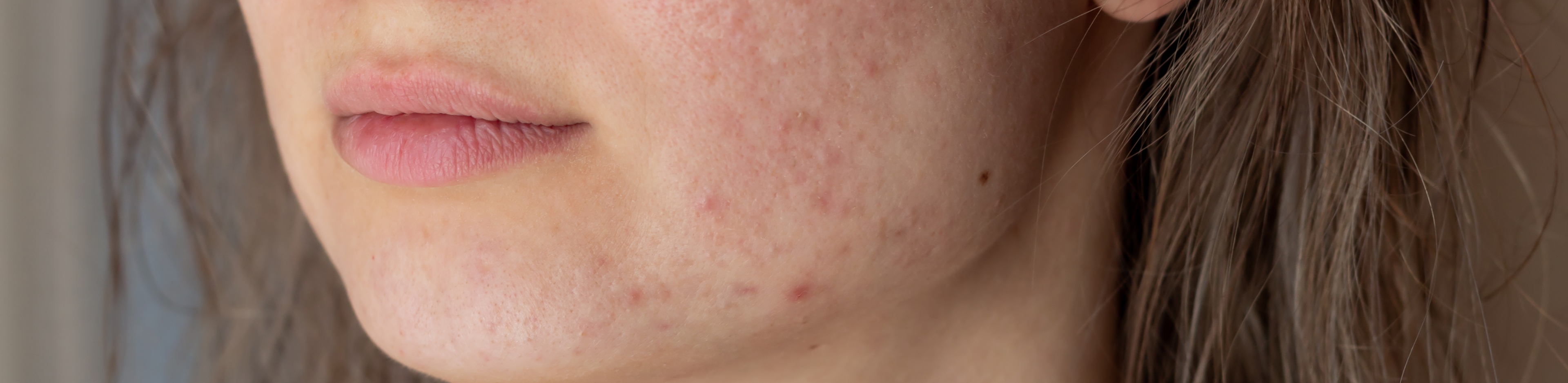 Le lien entre alimentation et acné : ce que dit la science