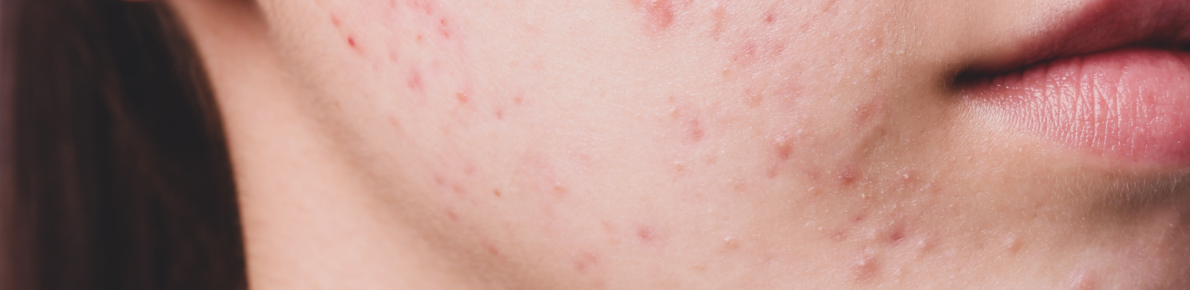 Acné non traitée : quels sont les vrais risques à long terme?