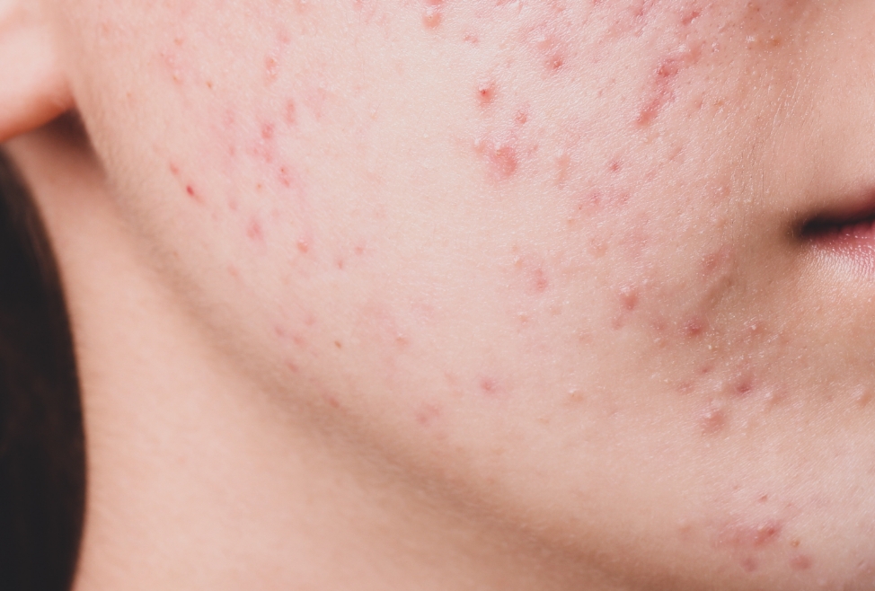 Acné non traitée : quels sont les vrais risques à long terme?