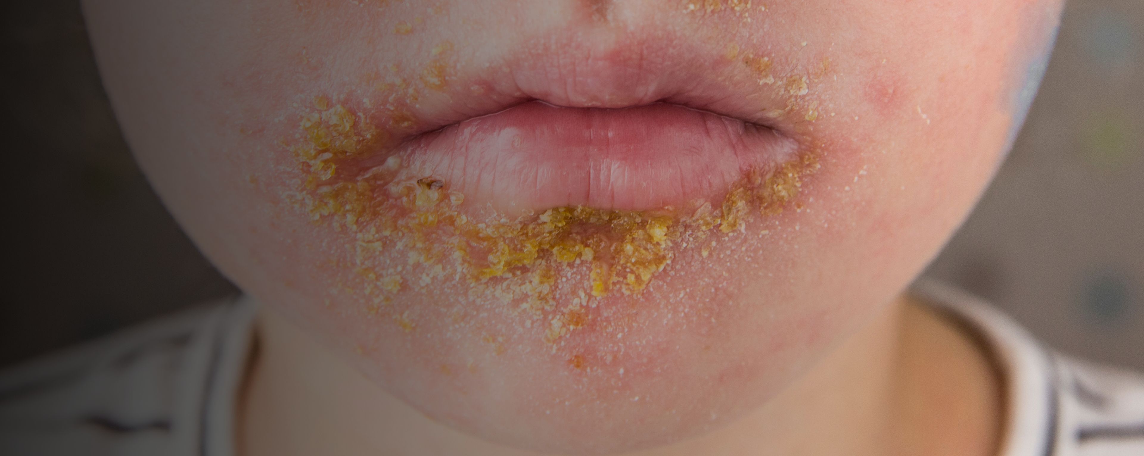 Close-up of impetigo around a child’s mouth.